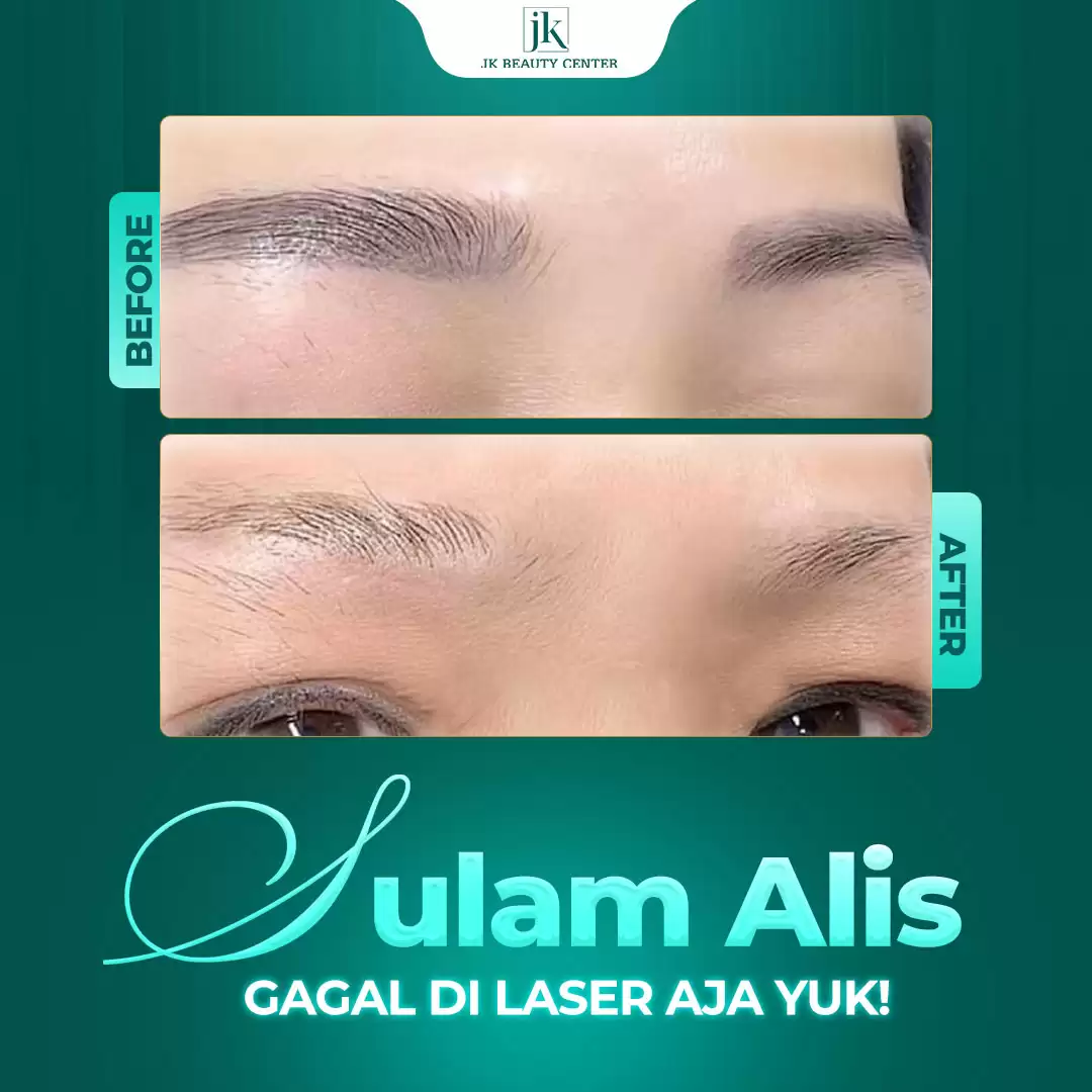 Penghapusan Sulam Alis dengan Laser Picosure Di JK Beauty Center, aman nggak ya?