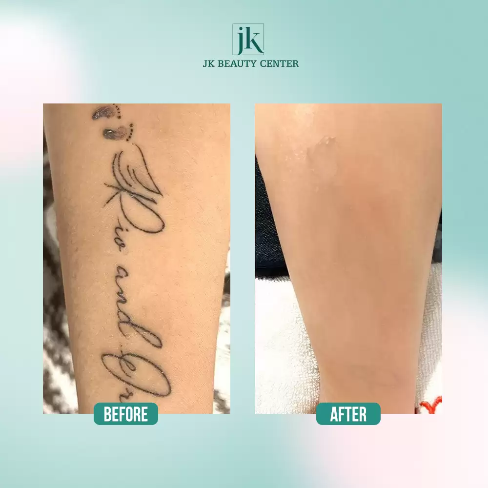 Penghapusan tato body dengan Laser Picosure – Aman, tidak meninggalkan bekas luka 