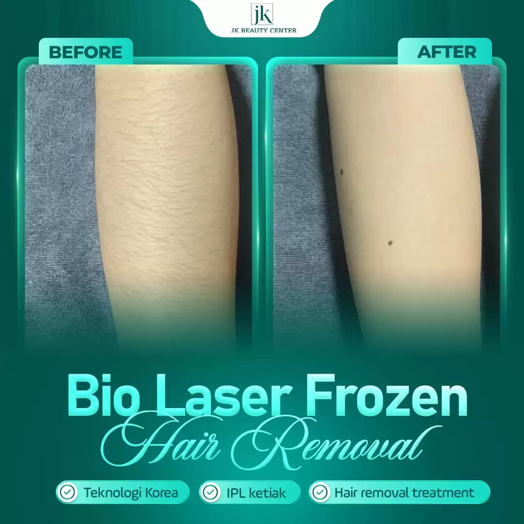 Bio Laser Frozen – Teknologi hair removal terbaru saat ini