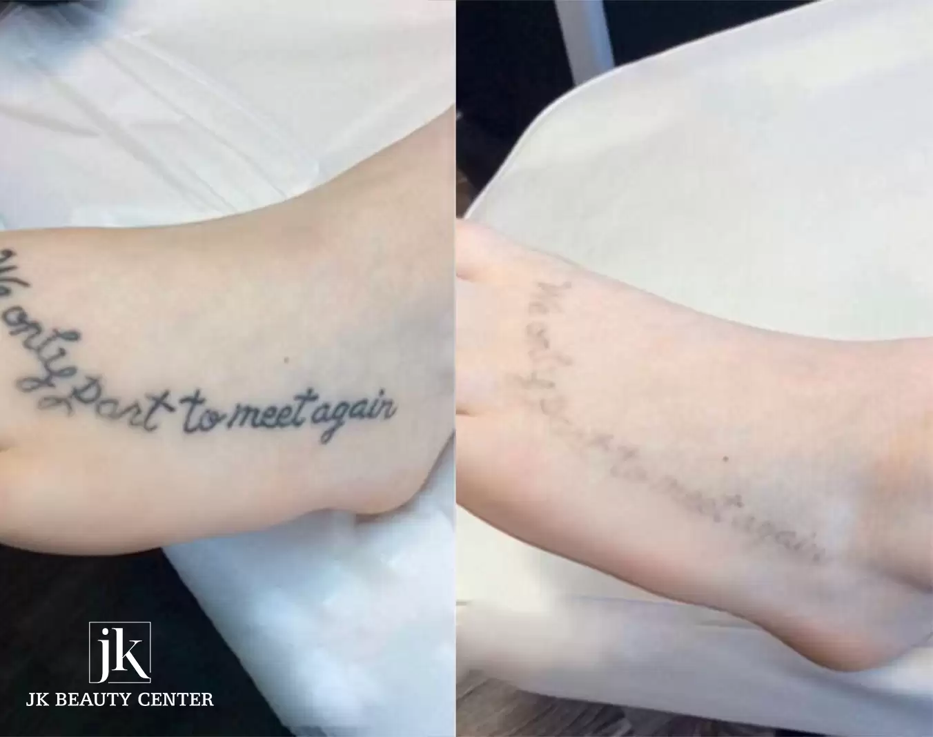 Penghapusan tato body dengan Laser Picosure – Aman, tidak meninggalkan bekas luka 