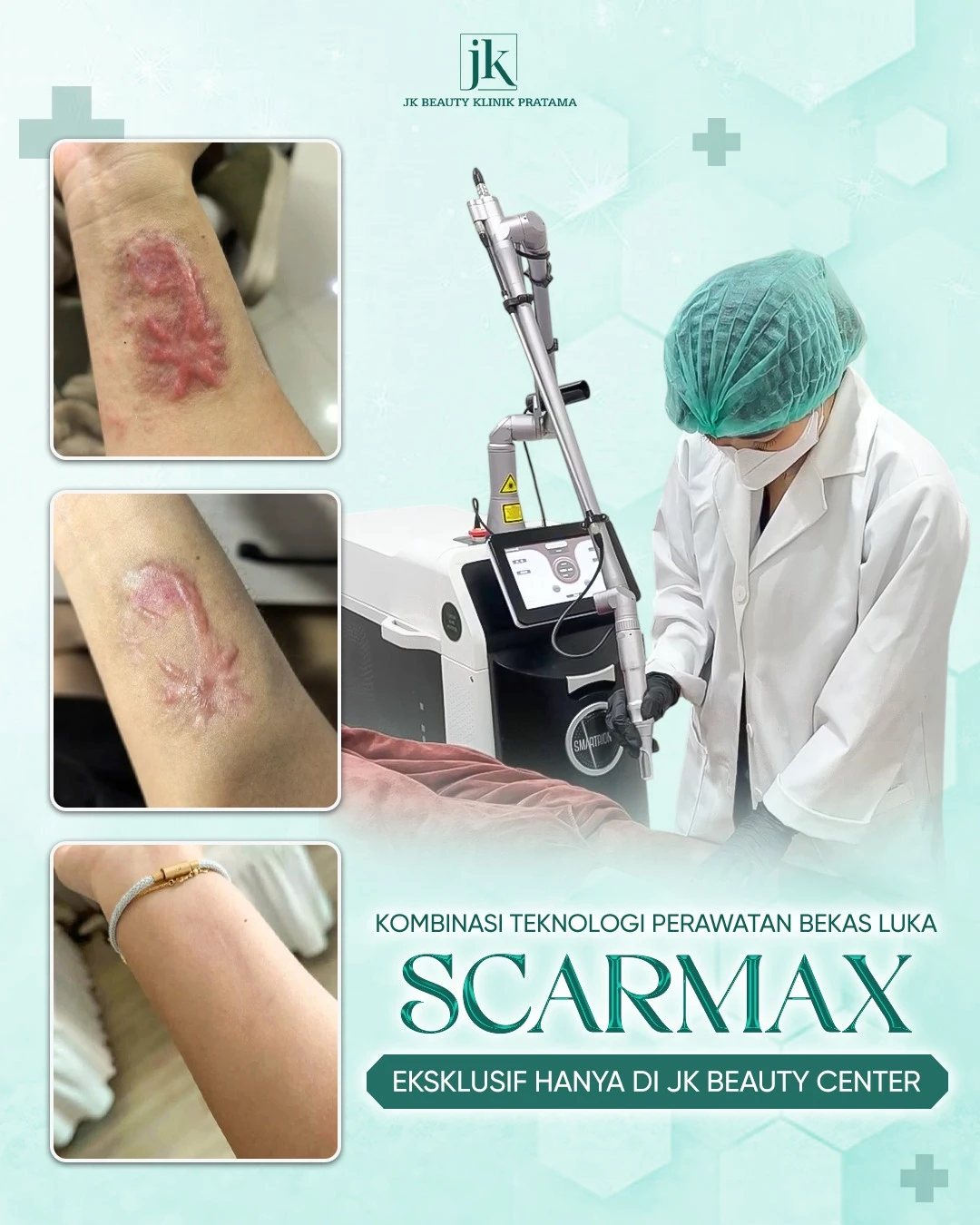 Apakah perawatan laser untuk bekas luka keloid efektif? Keuntungan dan proses perawatan