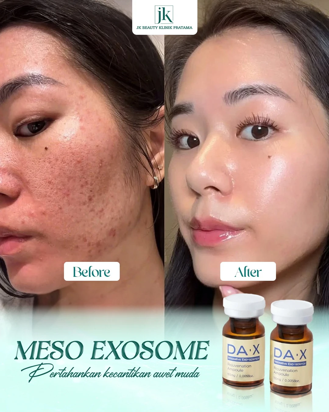 Berapa Lama Suntikan Meso Berhasil? Mengungkap Waktu Standar Efek untuk Setiap Jenis Kulit