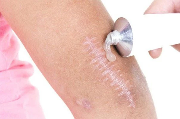 Apa itu Scar removal gel? Apakah benar-benar seefektif yang diiklankan?