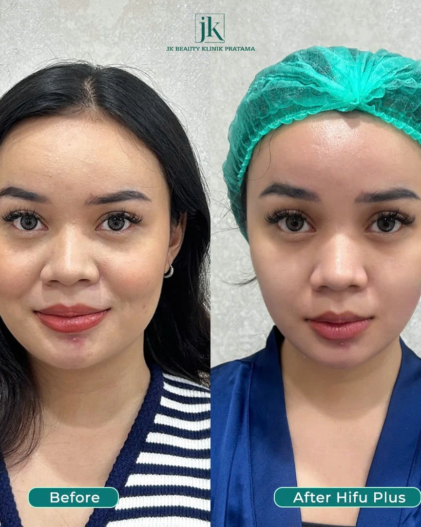 Apakah facelift HIFU lebih baik daripada metode kosmetik non-invasif lainnya?