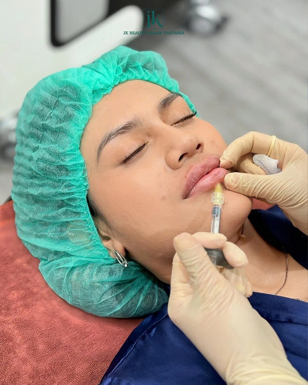 Collagen Stimulator Injection: Solusi Peremajaan Kulit Alami, Membentuk Wajah Lebih Harmonis Tanpa Operasi