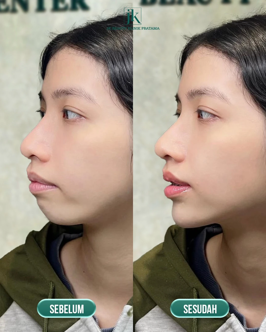 Mengapa Collagen Stimulator Injection lebih efektif dibandingkan metode peremajaan populer lainnya?