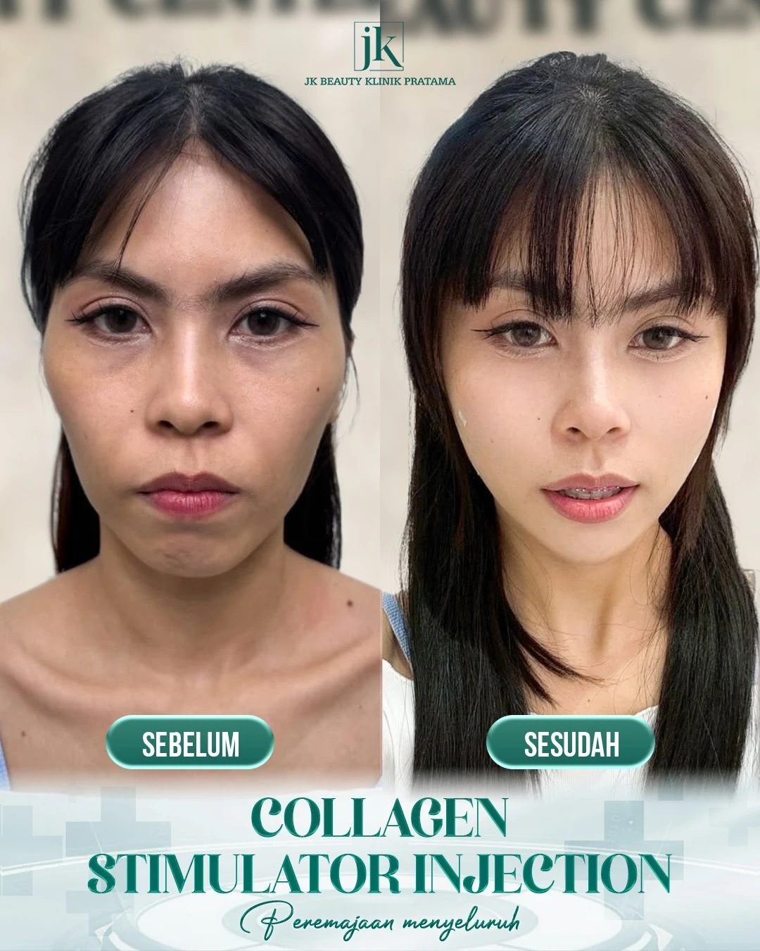 Mengapa Collagen Stimulator Injection lebih efektif dibandingkan metode peremajaan populer lainnya?
