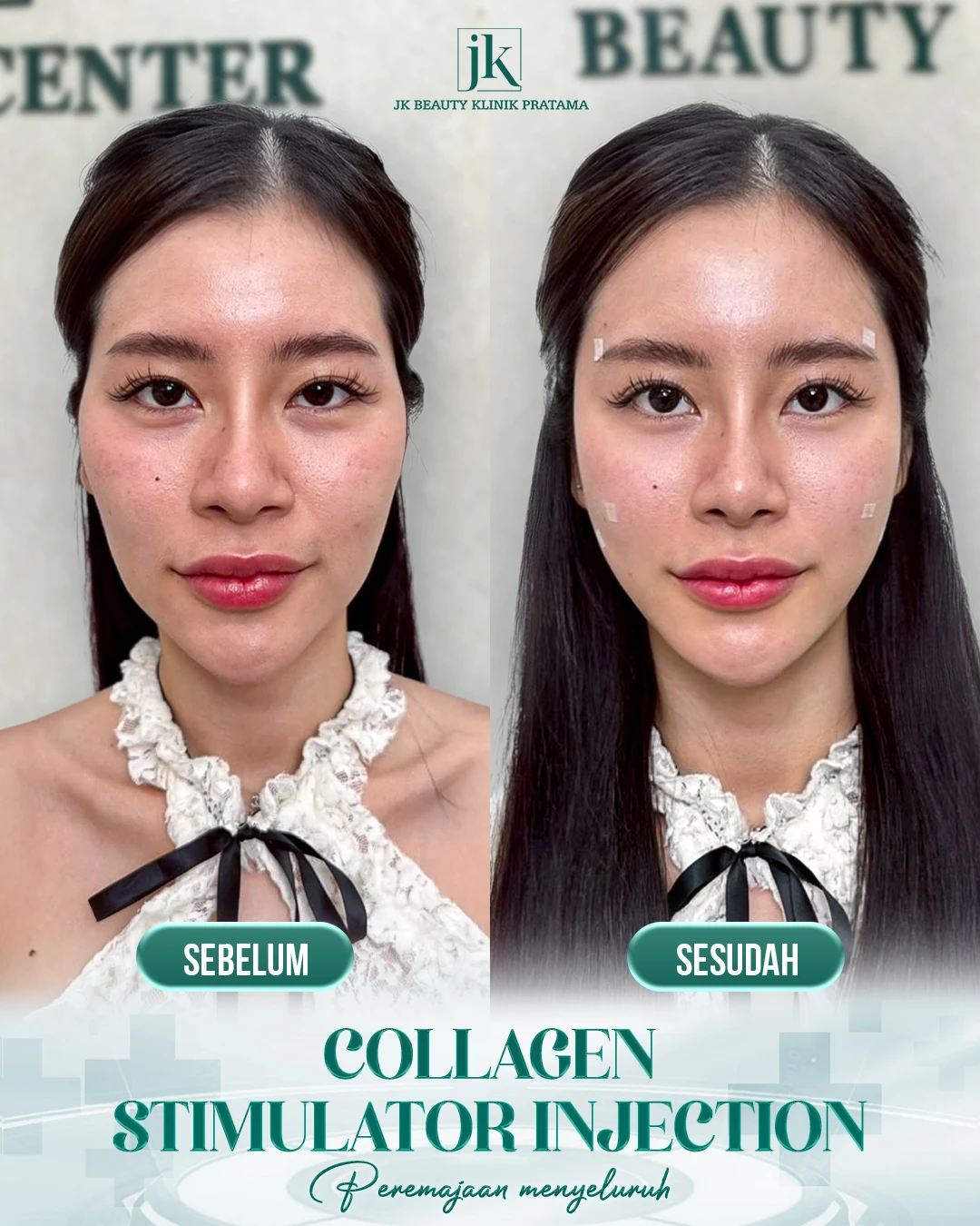 Collagen Stimulator Injection – Langkah Inovatif untuk Peremajaan Alami dengan Efek Ganda di JK